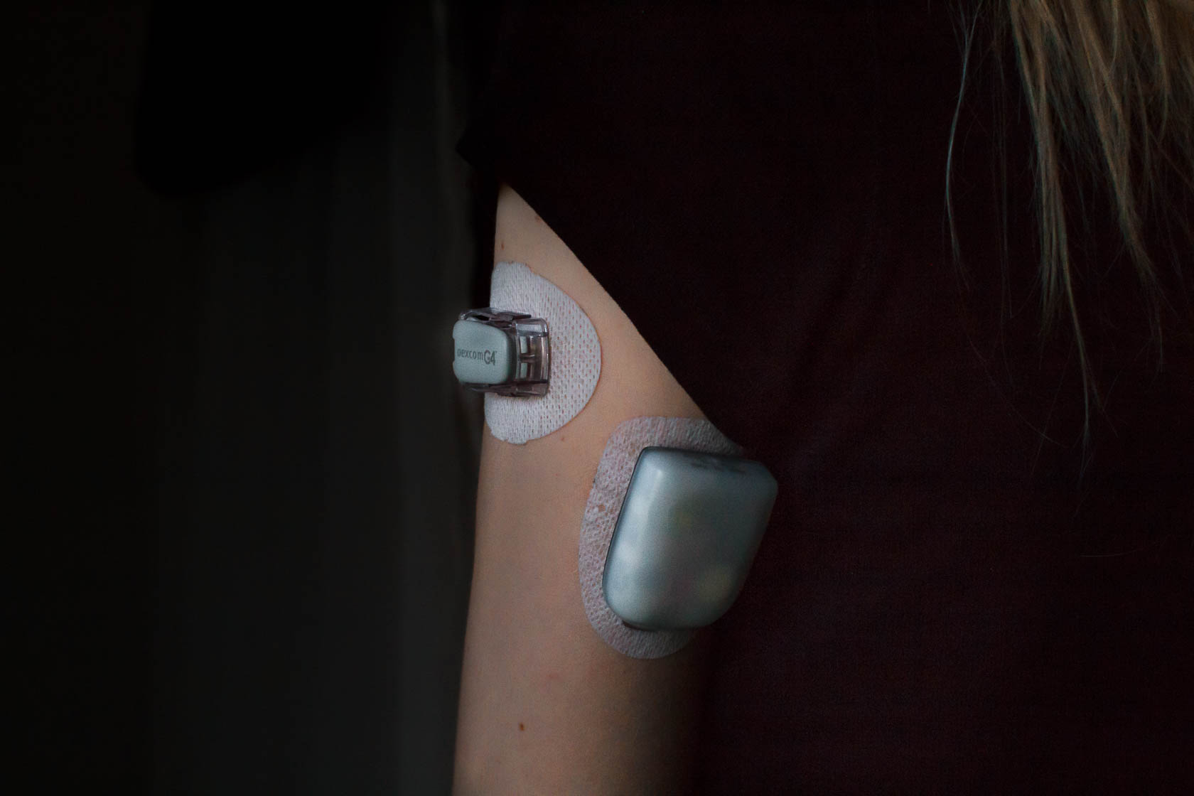Omnipod og glukosesenor - diabetes